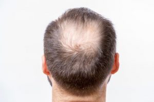 chute de cheveux alopecie et chimiotherapie