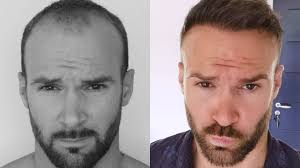 Avantages-greffe-de-cheveux-Choi