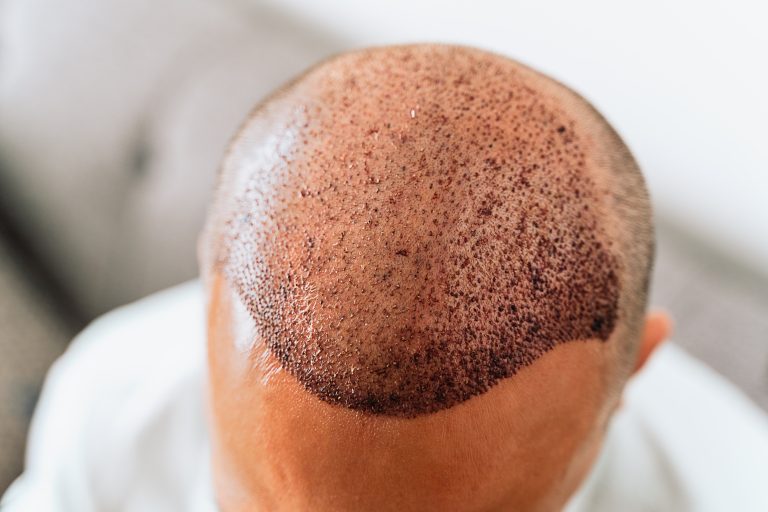 Avantages-greffe-de-cheveux-choi