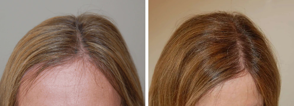 Cas-concret-greffe-capillaire-cheveux-fins-choi