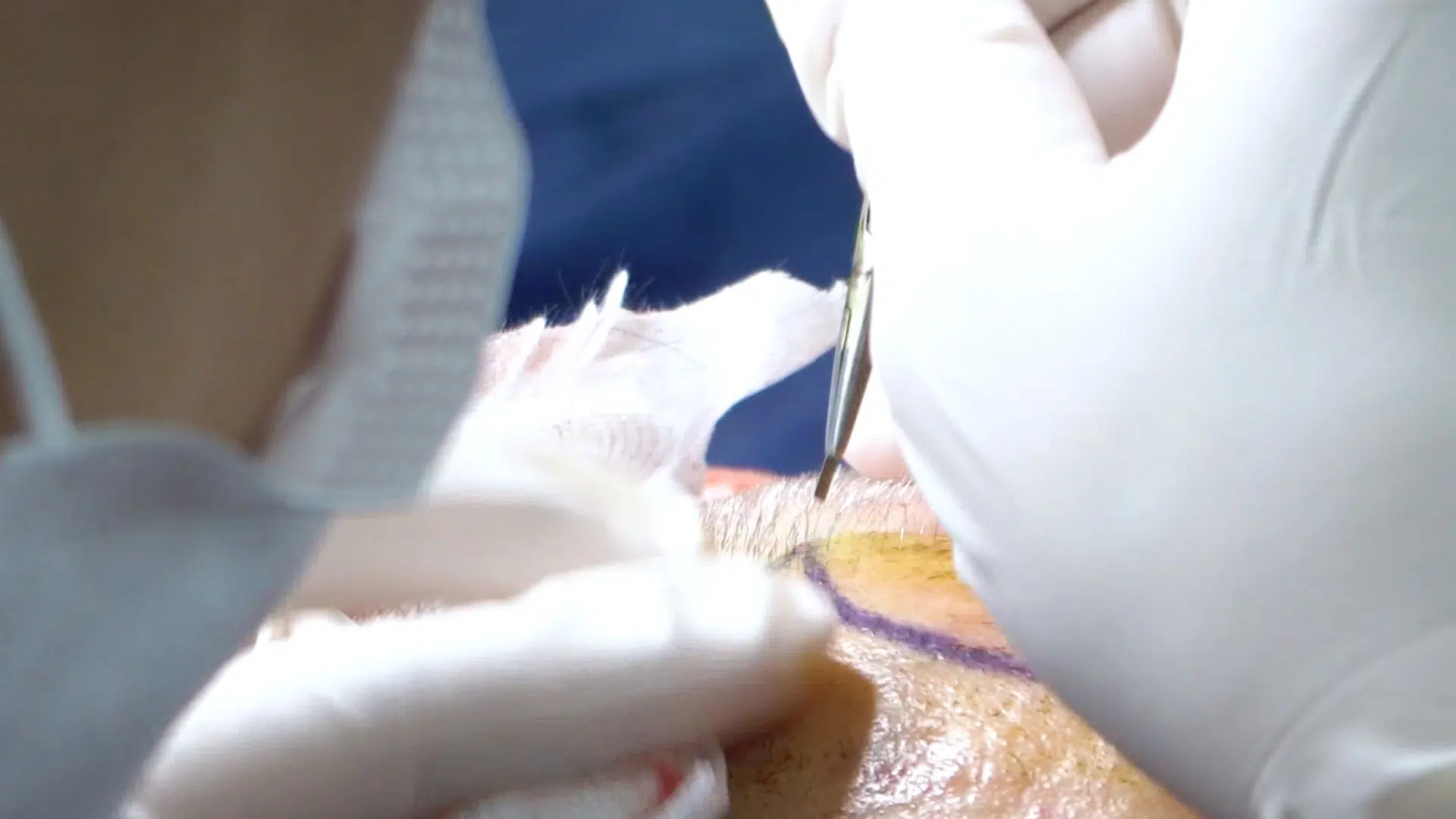 Greffe capillaire : quelle technique choisir entre Saphir FUE et Choi ?