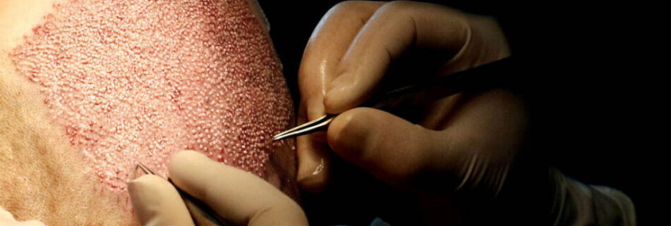 Fonctionnement-greffe-capillaire-technique-Choi