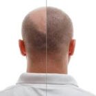 Greffe-de-cheveux-Choi-avant-apres