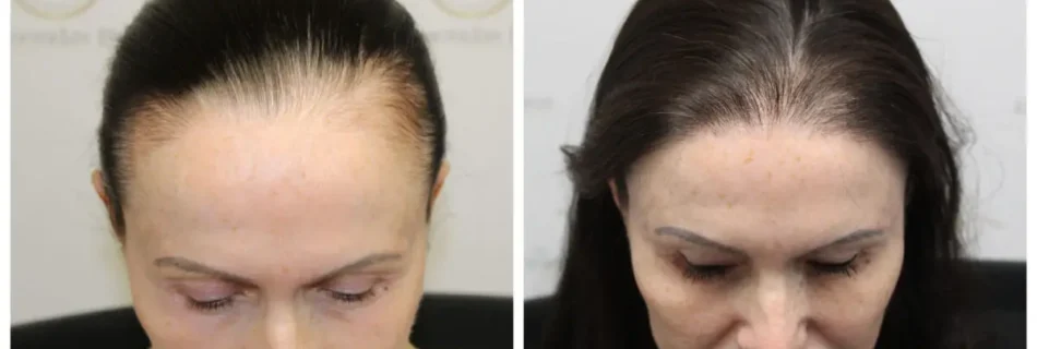 Greffe-de-cheveux-Choi-femme