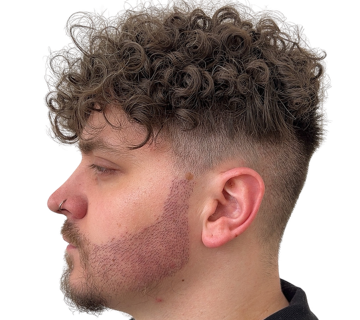 Greffe-capillaire-cheveux-boucles-technique-choi