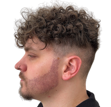 Greffe-capillaire-cheveux-boucles-technique-choi