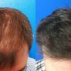 Greffe-capillaire-cheveux-fins-choi