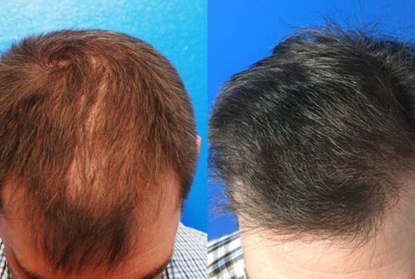 Greffe-capillaire-cheveux-fins-choi