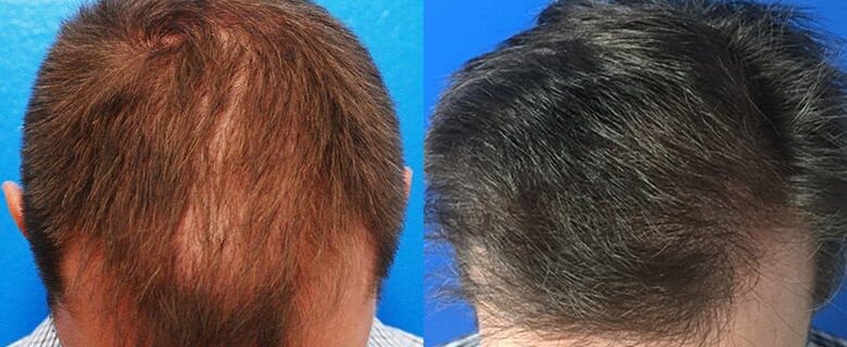 Greffe-capillaire-cheveux-fins-choi