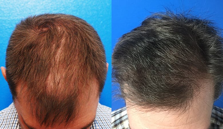 Greffe capillaire pour cheveux fins : pourquoi la Choi est adaptée