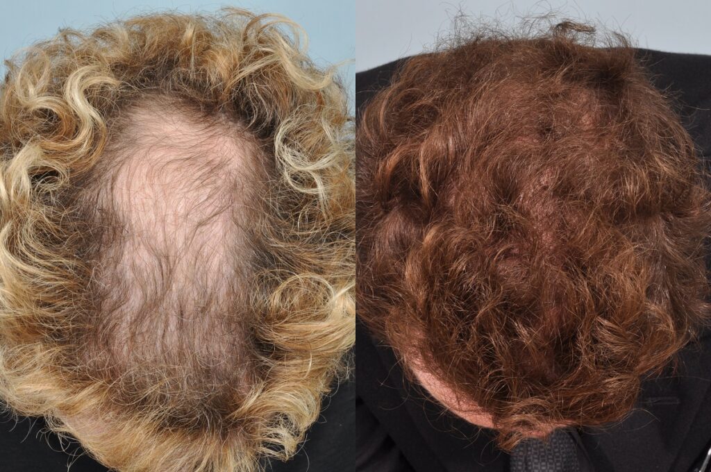 Greffe-de-cheveux-choi-cheveux-boucles