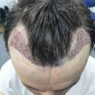 Greffe-de-cheveux-sans-rasage