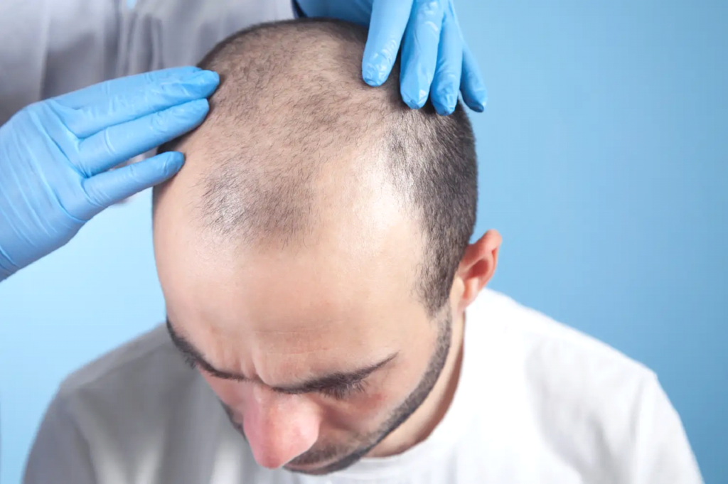 Greffe-de-cheveux-choi-pour-qui