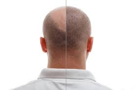 Préparation du cuir chevelu et coloration éventuelle avant une greffe de cheveux