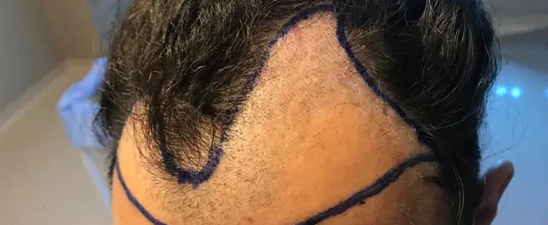 Preparer-cuir-chevelu-avant-greffe-capillaire-Choi