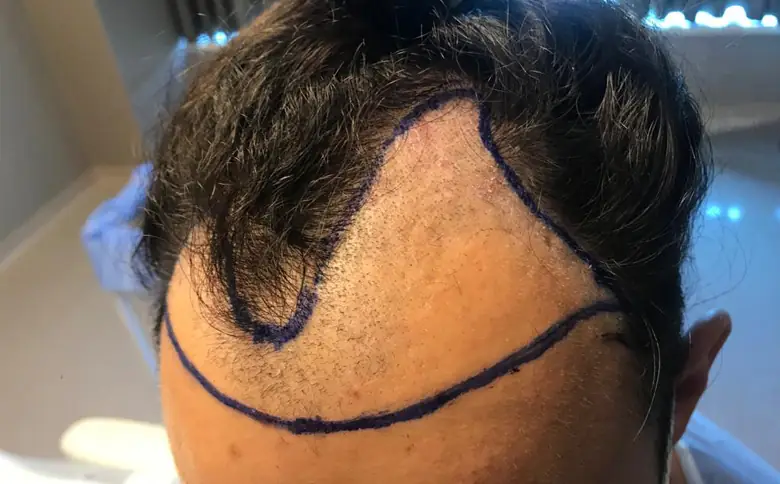 Comment préparer votre cuir chevelu avant une greffe Choi