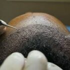 Technique-choi-autres-techniques-greffe-de-cheveux