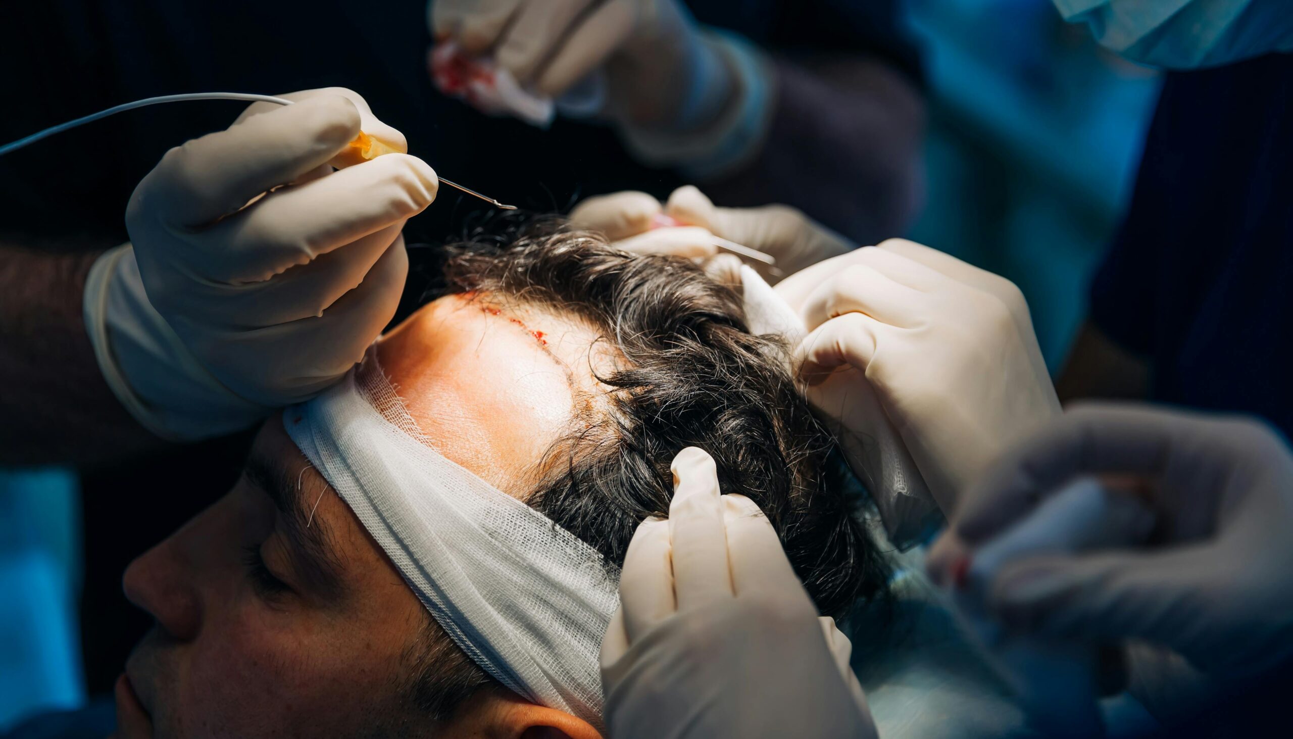  Top 10 des meilleures cliniques de greffe capillaire en France (2025)