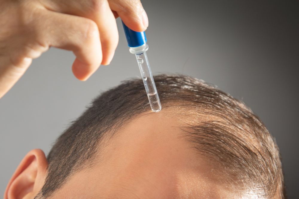 Greffe de cheveux : Minoxidil pour ou contre