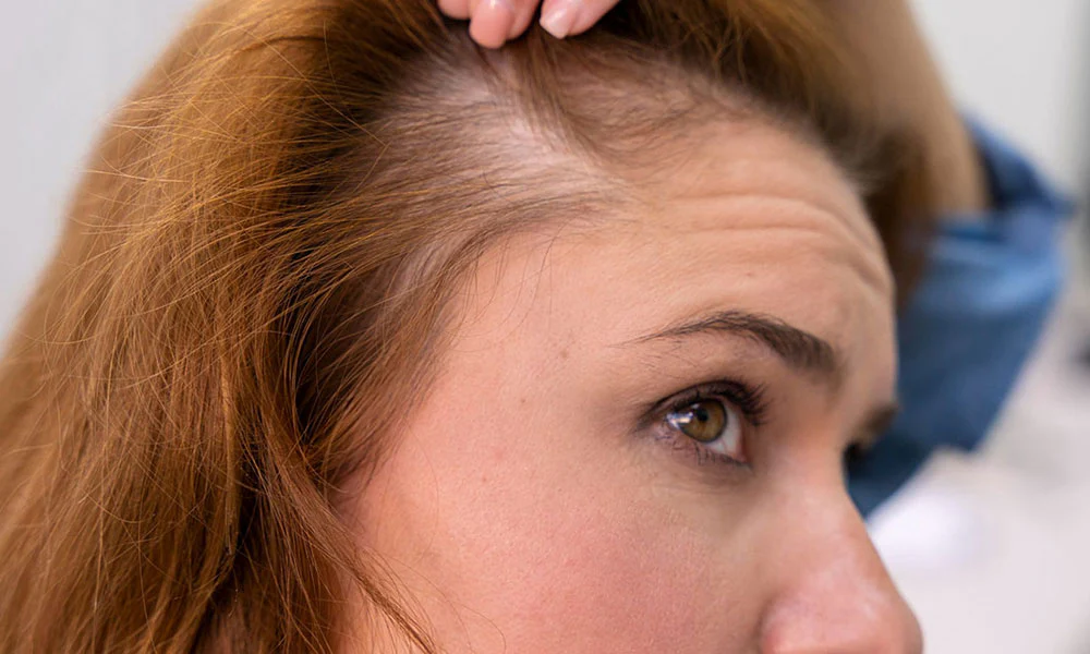 Comprendre-chute-de-cheveux-feminine