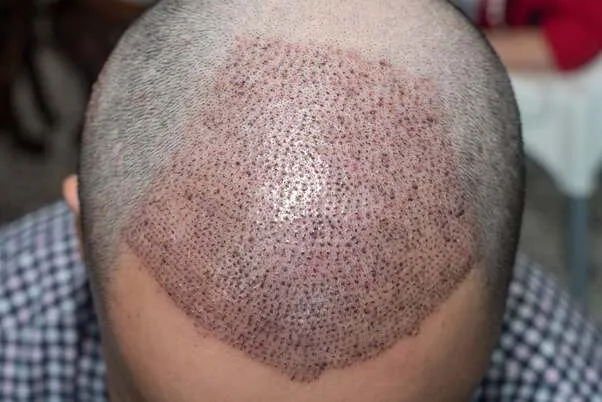Criteres-evaluer-clinique-greffe-de-cheveux