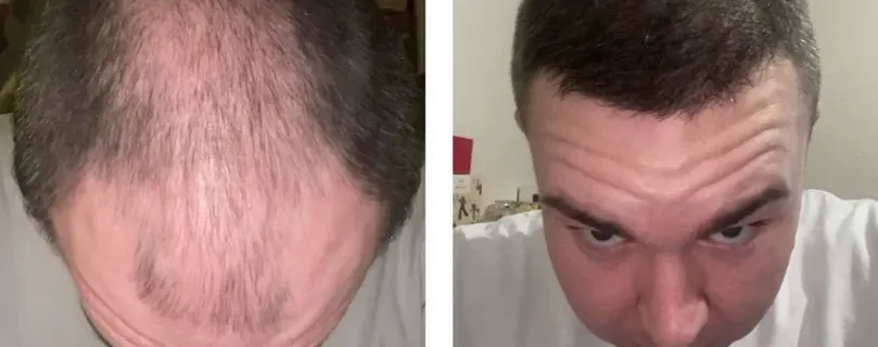 Dormir-apres-greffe-capillaire-Choi