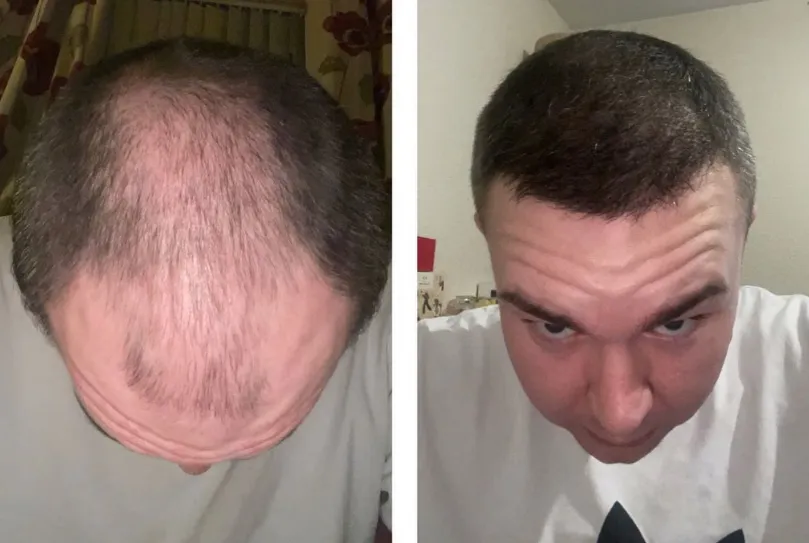 Comment dormir après une greffe de cheveux Choi ?