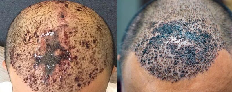 Effets-secondaires-greffe-capillaire