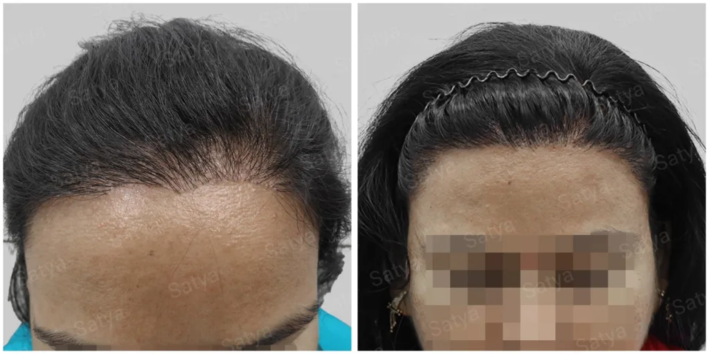 Greffe-de-cheveux-femme-technique