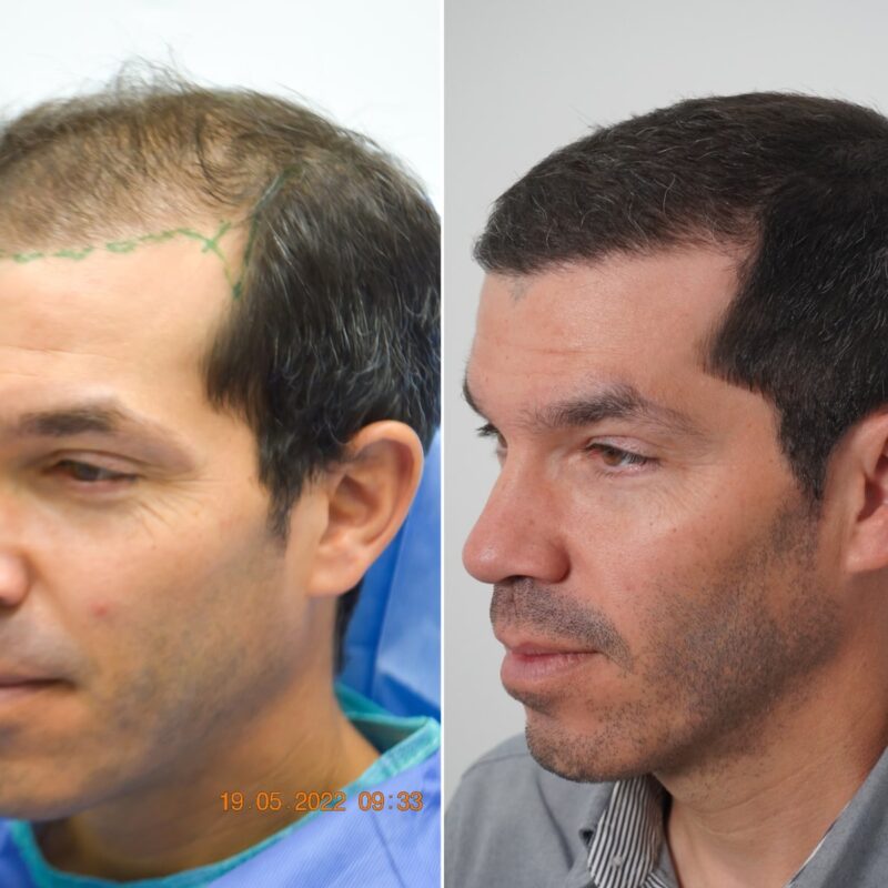 Greffe-de-cheveux-pas-chere-mais-fiable