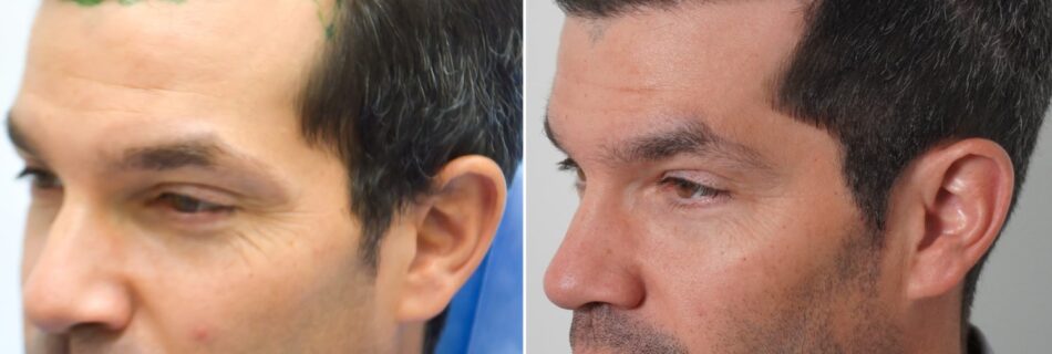 Greffe-de-cheveux-pas-chere-mais-fiable