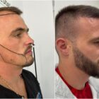 Transplantation-de-barbe-Paris