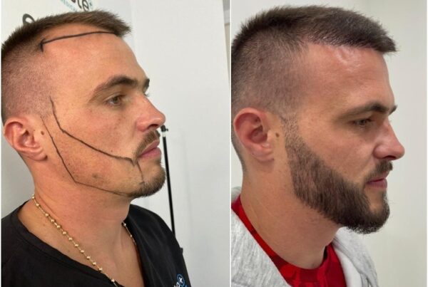 Transplantation-de-barbe-Paris