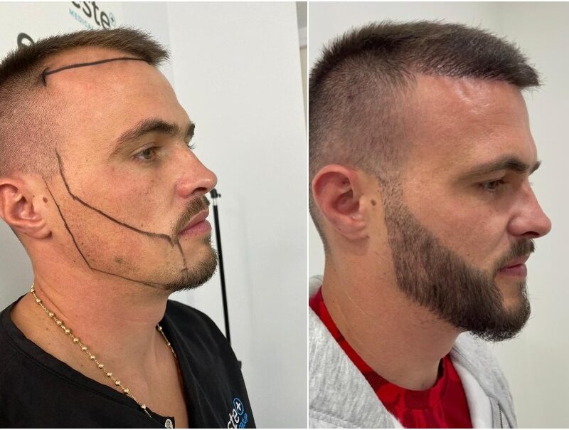 Transplantation-de-barbe-Paris