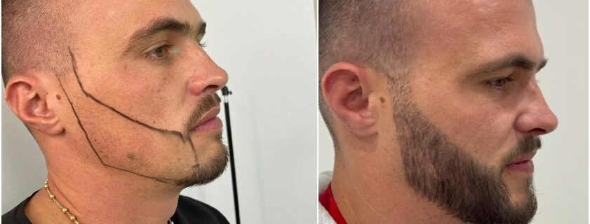 Transplantation-de-barbe-Paris