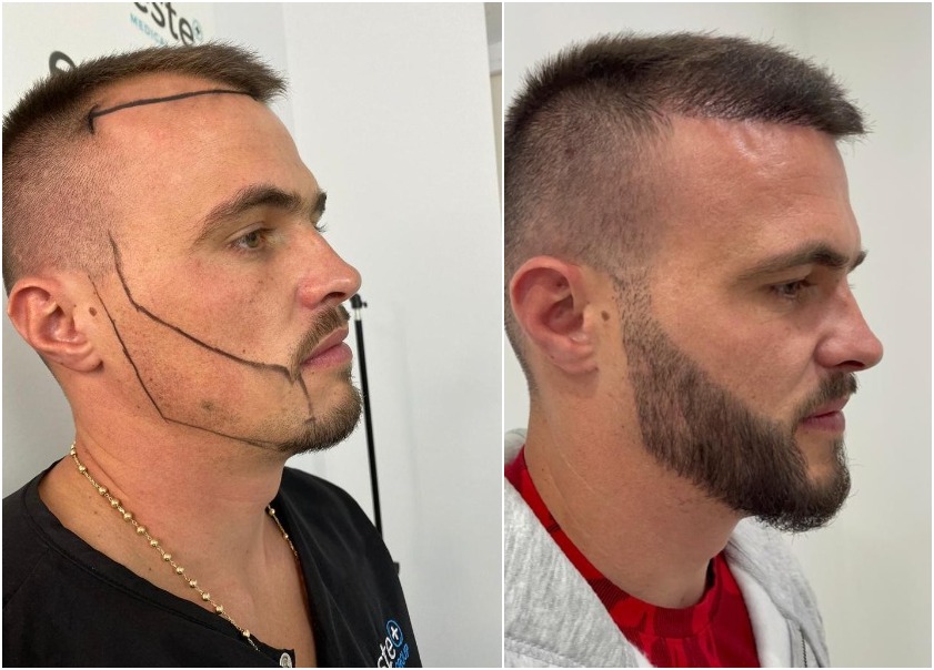 Greffe de barbe à Paris : techniques, résultats et conseils pratiques