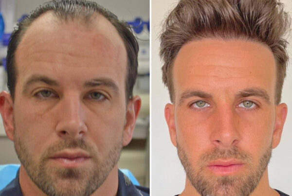 Greffe-capillaire-Bordeaux