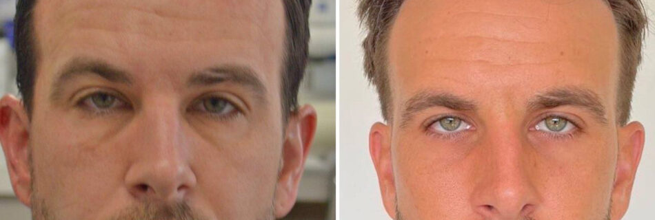 Greffe-capillaire-Bordeaux