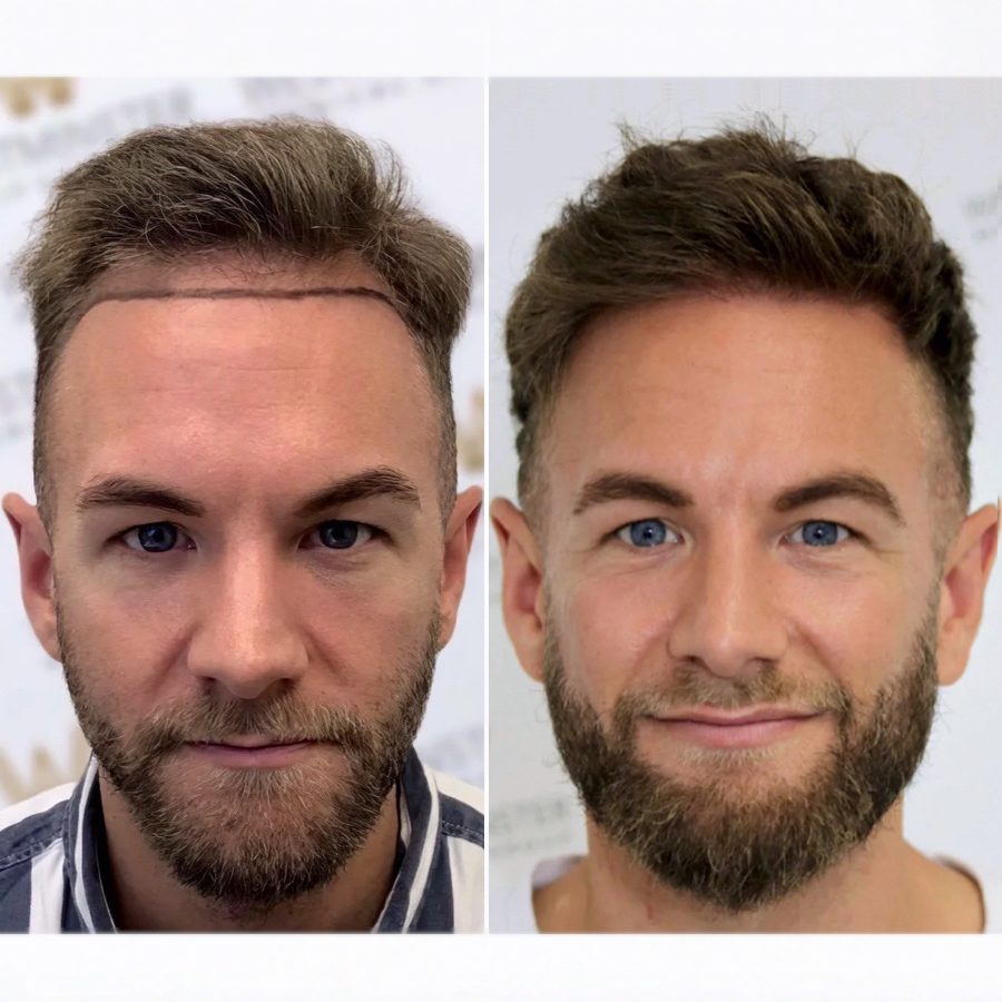 Greffe de cheveux en Espagne : avis, atouts et limites