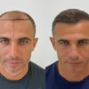 Greffe-capillaire-France-Turquie-differences