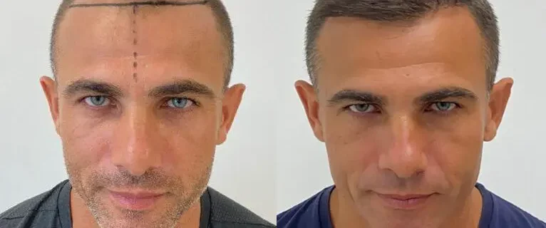 Greffe-capillaire-France-Turquie-differences