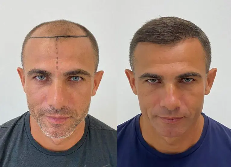 Greffe de cheveux : France vs Turquie, quelles différences ?