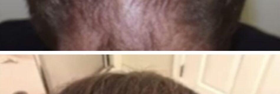 Greffe-capillaire-Lille