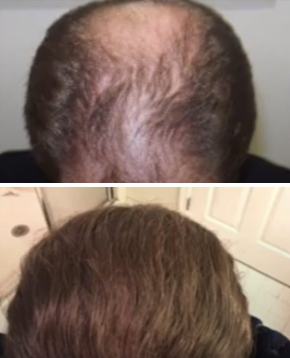 Greffe de cheveux à Lille : techniques, prix et choix des cliniques