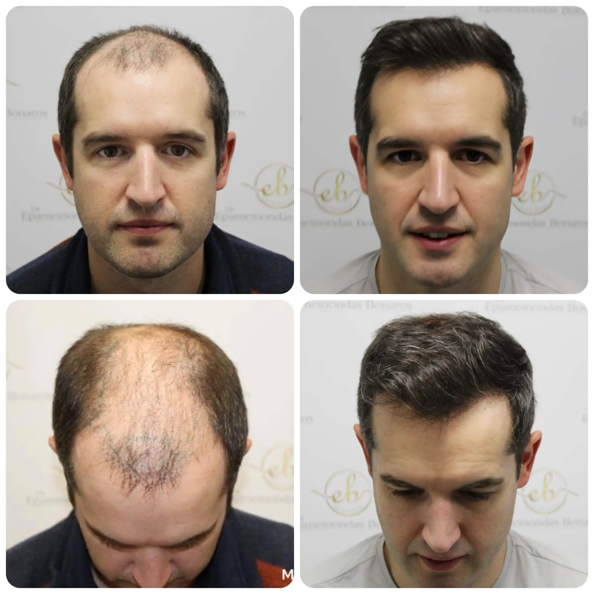 Greffe de cheveux à Lyon : techniques, prix et choix des cliniques