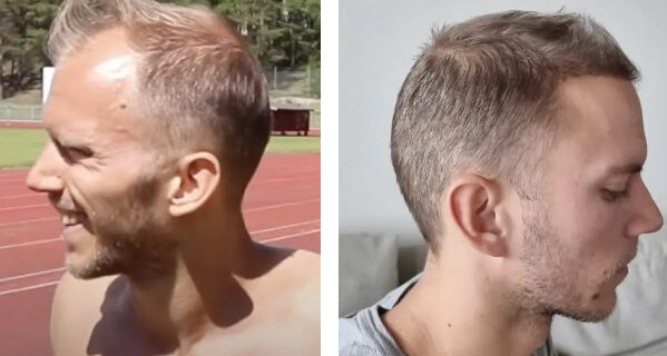 Greffe-capillaire-remboursement-securite-sociale