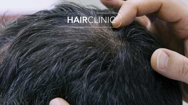 Avis-Hair-Clinic-Marseille