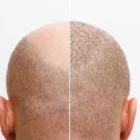 Histoire-origine-greffe-de-cheveux-Choi
