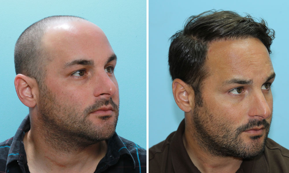 Implant-de-cheveux-Bordeaux