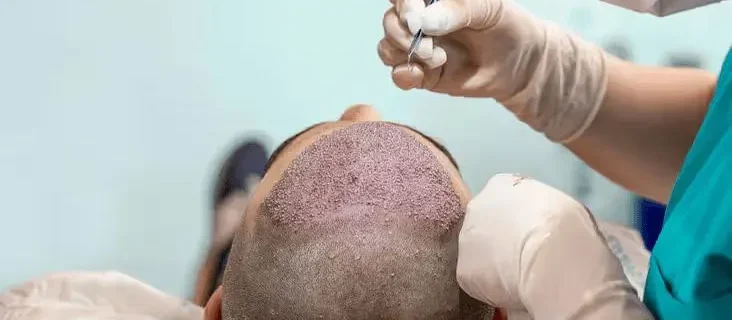 Incision-cicatrice-visible-technique-CHOI